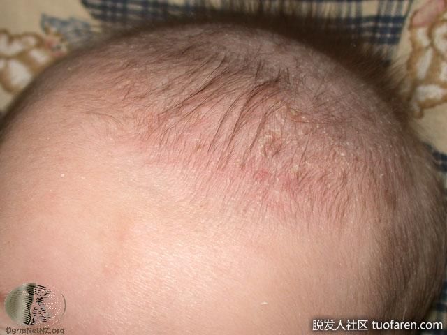 嬰兒脂溢性皮炎圖片2