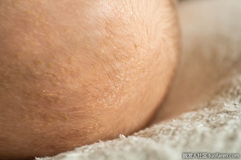 嬰兒脂溢性皮炎圖片3