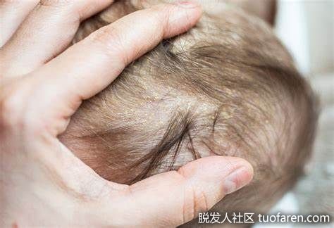 嬰兒脂溢性皮炎圖片4