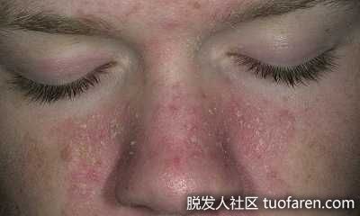 脂溢性皮炎面部照片1