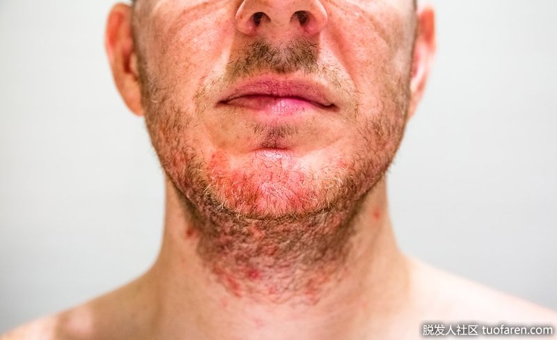脂溢性皮炎面部照片2
