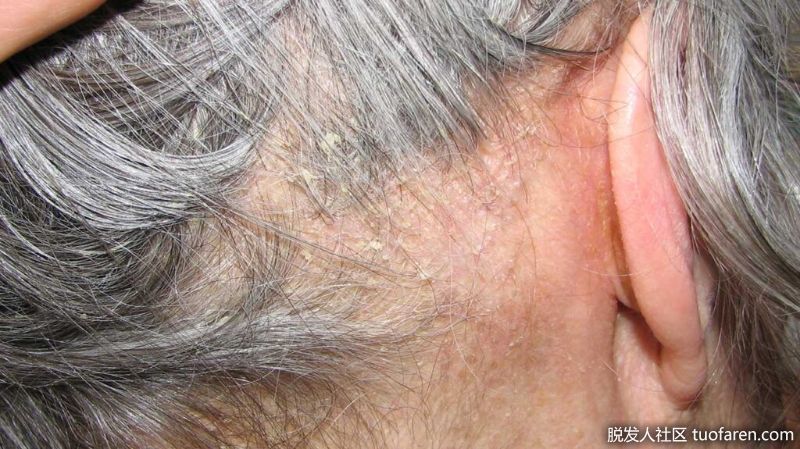 脂溢性皮炎面部照片3