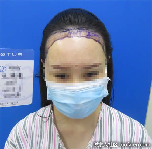 女性髮際線移植