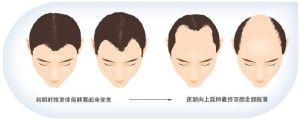 脱髮類型圖、脱髮等級對照圖