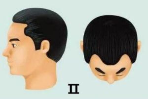 脱髮等級對照圖