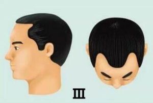 脱髮等級對照圖