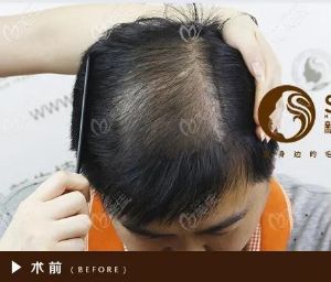 成都新生植髮圖片對比照片_真人實拍效果圖