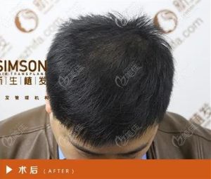 成都新生植髮圖片對比照片_真人實拍效果圖