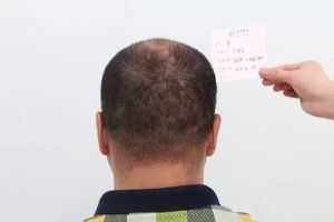 雍禾植髮圖片對比照片_真人實拍效果圖