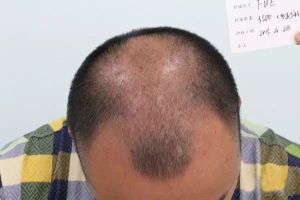 雍禾植髮圖片對比照片_真人實拍效果圖