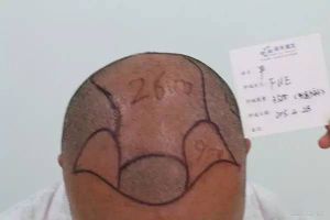 雍禾植髮圖片對比照片_真人實拍效果圖