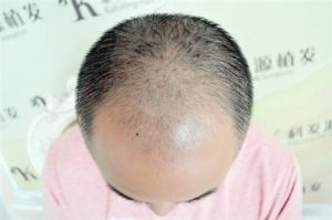 大麥植髮「科髮源植髮」失敗修復案例_真人實拍效果圖