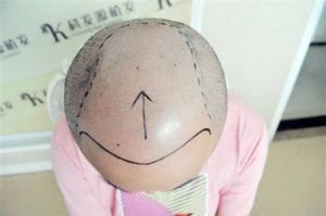 大麥植髮「科髮源植髮」失敗修復案例_真人實拍效果圖