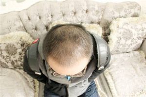 大麥植髮「科髮源植髮」失敗修復案例_真人實拍效果圖