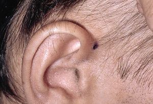 休止期脱髮圖 休止期脱髮髮根圖