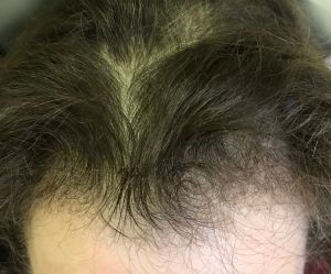 休止期脱髮圖 休止期脱髮髮根圖