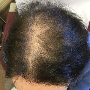 女性瀰漫性脱髮