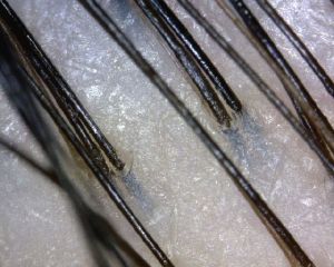 正常頭皮毛囊圖