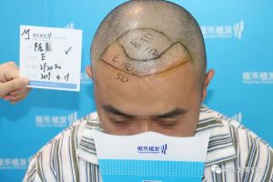 髮際線種植案例