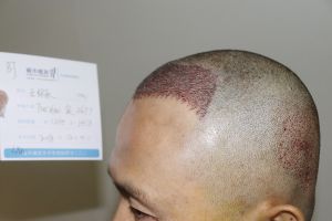 髮際線後移術後