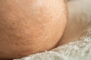 嬰兒脂溢性皮炎圖片