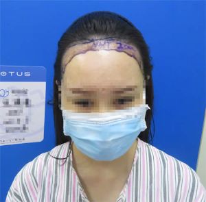 女性髮際線移植